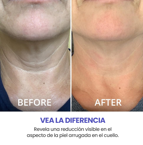 GOPURE – Lifting y Reafirmante para el Cuello